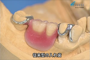 従来型の入れ歯