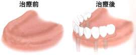 歯を何本か失った場合（治療前・治療後）