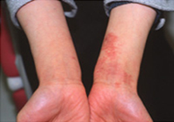 アトピー性皮膚炎や掌蹠膿疱症