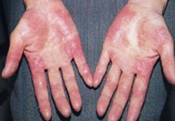 アトピー性皮膚炎や掌蹠膿疱症