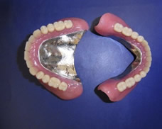 Co-Cr金属床義歯